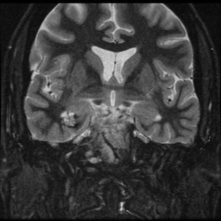 Cavernoma | Image | Radiopaedia.org