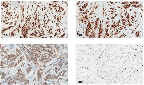 Discordance Of Her2 Positive Classic Invasive Lobular Carcinoma Between