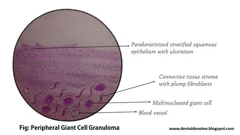 Peripheral Giant Cell Granuloma Histology