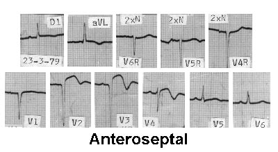 anteroseptal