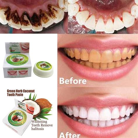 Coconut Oil Before And After Teeth