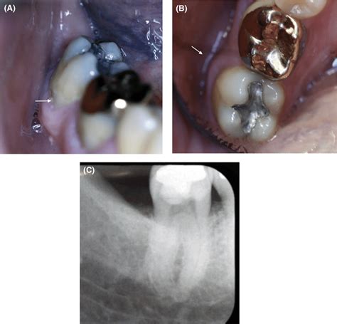 A, Intraoral view demonstrating recently placed restoration on buccal... | Download Scientific ...