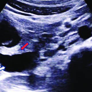 A 21-year-old male with Groove Pancreatitis. Contrastenhanced computed... | Download Scientific ...