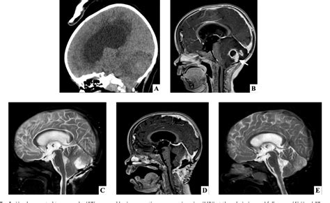 [pdf] A Rare Presentation Of Occipital Dermoid Cyst With Intracranial