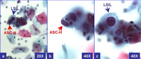 LSIL-H (with CIN2 & HPV in biopsy): Cervical smear with unequivocal ...