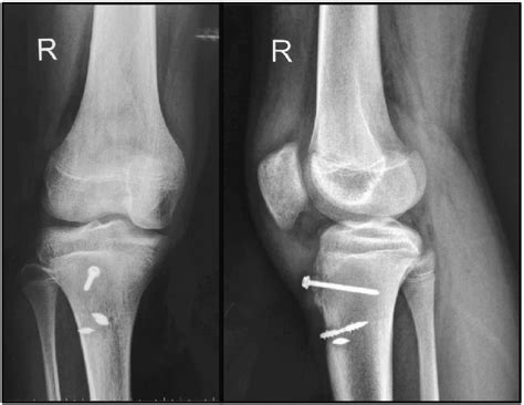 Post Operative Radiograph Anterior Posterior And Lateral Of Right Knee