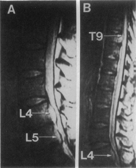 A Caution About The Use Of Mri To Diagnose Spinal Cord Compression