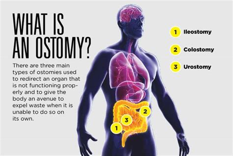 Living With An Ostomy Pouch Mountainview Hospital