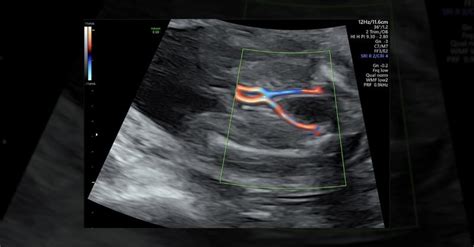 Diagnosis Of Single Umbilical Artery And Fetal Demise In Multigravida