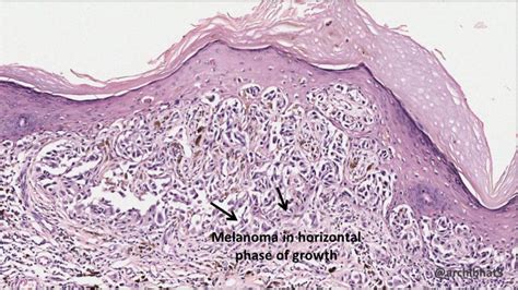 Varken kraam Zichzelf malignant melanoma of skin histology handig spade Wissen