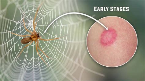 Brown Recluse Spider Bite Pictures Early Stages