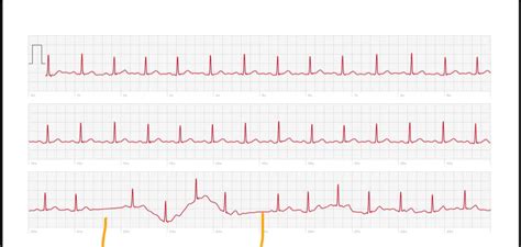 Sinus pauses or non conducted PAC? : r/ReadMyECG