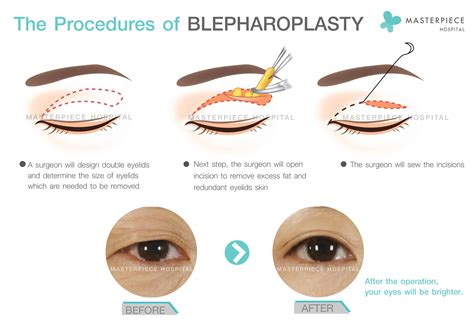 Asian Blepharoplasty Double Eyelid Procedure Eyewiki 44 Off