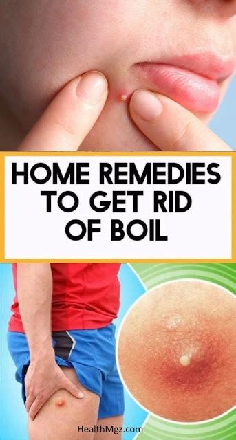 how to get rid of a boil overnight home remedies