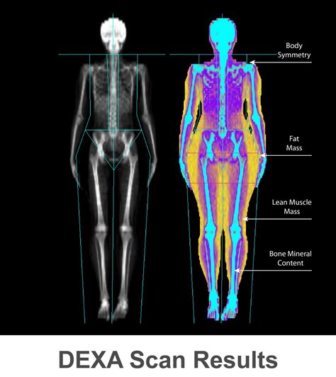 Dexa Dxa Scan Bone Density Test Accurate Imaging Diagnostics