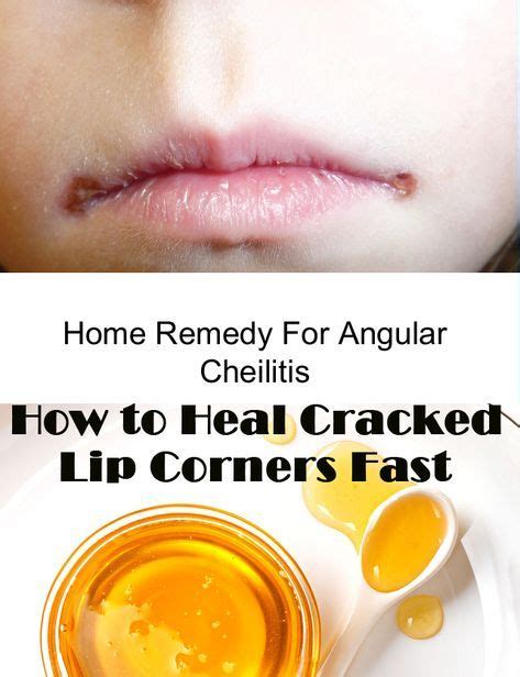 9 Angular Cheilitis Ideas Cracked Corners Of Mouth Angular Cracked Lips