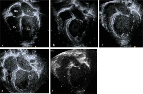 Four Chamber Apical Echocardiographic View Of A A Normal Heart With A