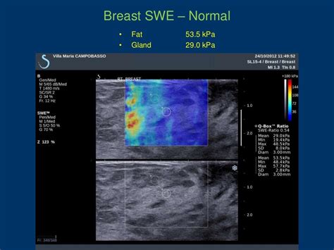 Breast elastography