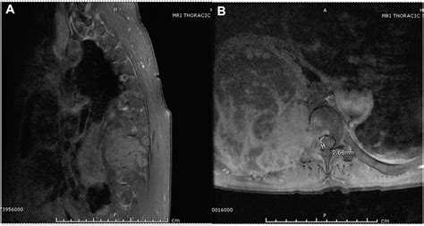 T1 Weighted Magnetic Resonance Imaging Mri Of The Thoracic Spine In Download Scientific