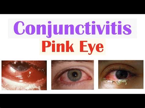 Acute Conjunctivitis Pink Eye Allergic Bacterial Viral Symptoms