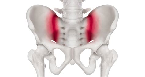 Understanding your SIJ pain - Life Ready Physio