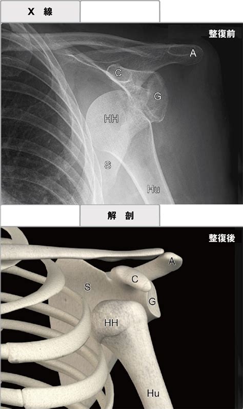 脱臼整復：肩関節 Procedures Consult
