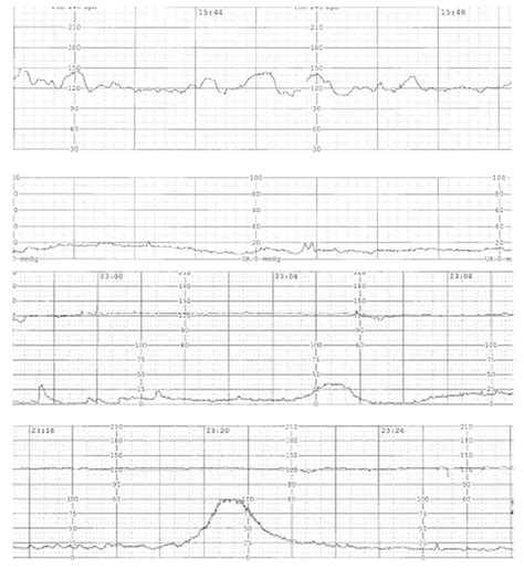 Fetal Heart Rate And Uterine Activity Monitoring On Day 16 Of Sinus Download Scientific Diagram