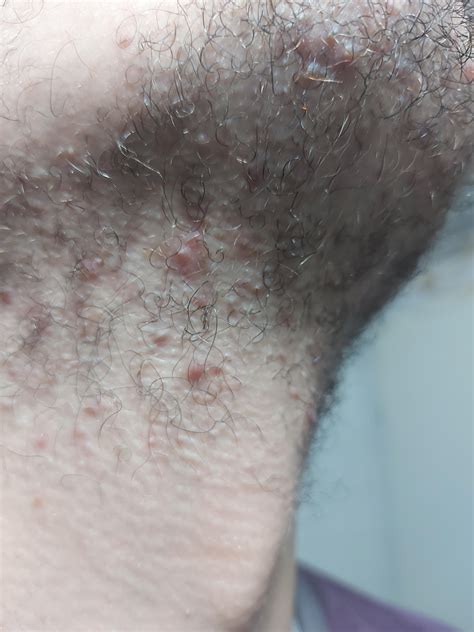 Pimples on my neck, multiplying : r/DermatologyQuestions