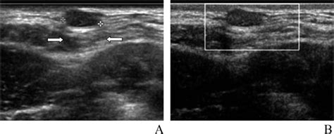 Scalp Lesions Ultrasound