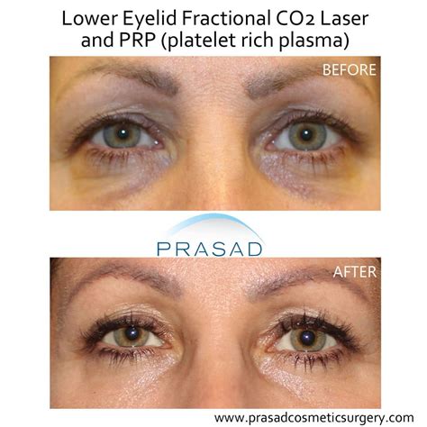 Benefits Of Prp Injection Under Eyes Dr Prasad New York