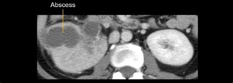 Abdominal Ct Renal Infections • Litfl • Radiology Library