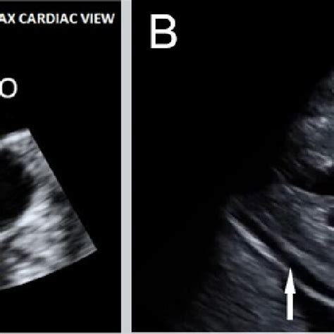 A Focused Cardiac Ultrasound Focus Parasternal Long Axis View