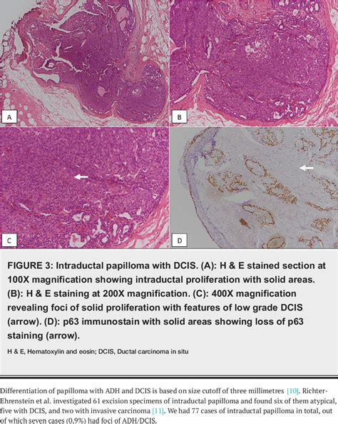 Figure 3 From Spectrum Of Papillary Breast Lesions According To World Health Organization