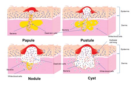 Aesthetic Treatment Singapore | Cystic Acne Treatments