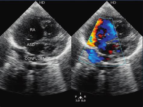 Transthoracic subcostal four chamber view showing dilated right atrium ...