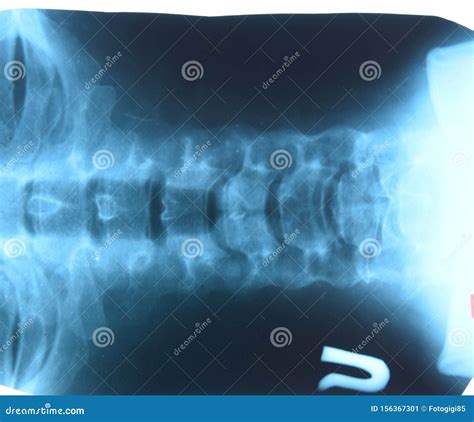 X-ray Of The Cervical Vertebrae. X Ray Image Of The Cervical Spine ...