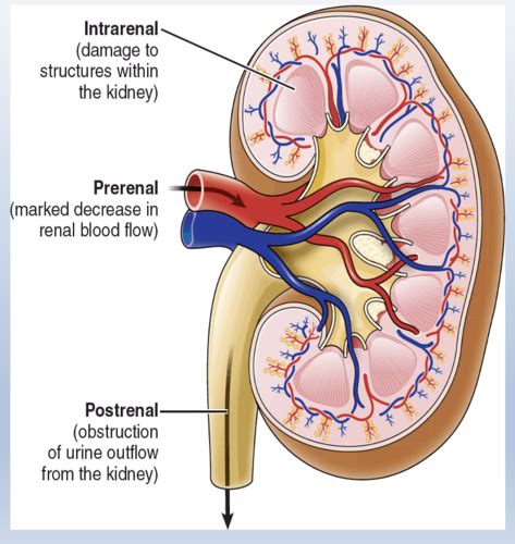 Exam Renal Flashcards Quizlet