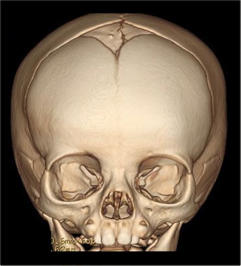 A 3d Ct Scan Of A Partially Fused Metopic Suture In A 8 Month Old