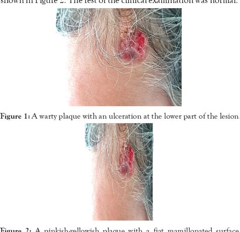 PDF Basal Cell Carcinoma On A Nevus Sebaceous Of Jadassohn Semantic