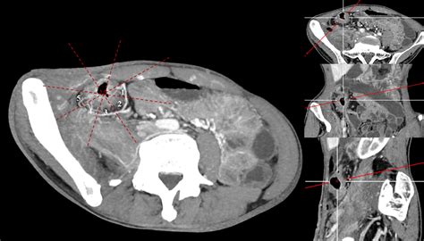 Mesenteric Creeping Fat Index Defined By Ct Enterography Is Associated