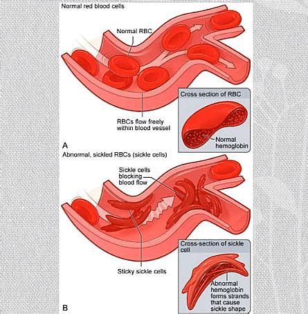 Sickle Cell Anemia Crisis Types Causes Symptoms Treatment And