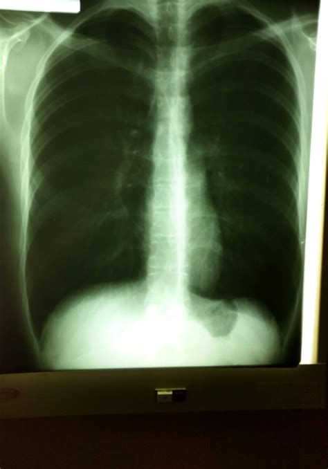 Tiny Heart 63 Asthenic Young Male Rradiology