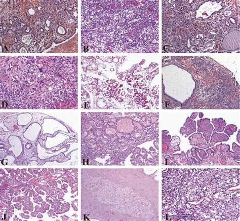 Nephrogenic Adenoma An Update On An Innocuous But Troubleso Advances In Anatomic Pathology