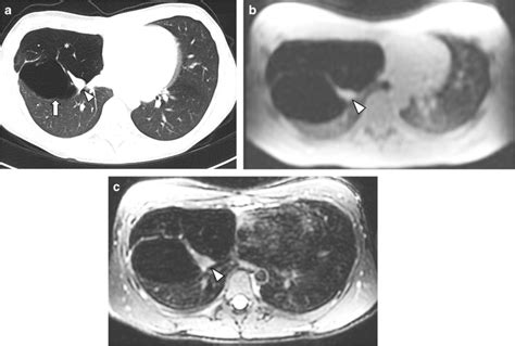 Bronchial Atresia And Congenital Lobar Hyperinflation In A Year Old