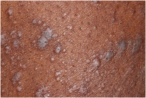 Dermatology Images Lichen Planus Journal Of The American Academy Of