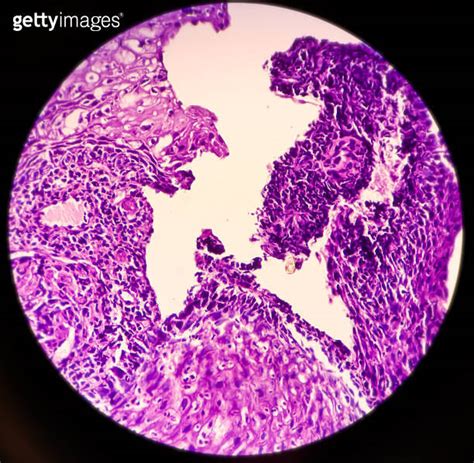 Microscopic Image Of Esophageal Cancer Invasive Squamous Cell