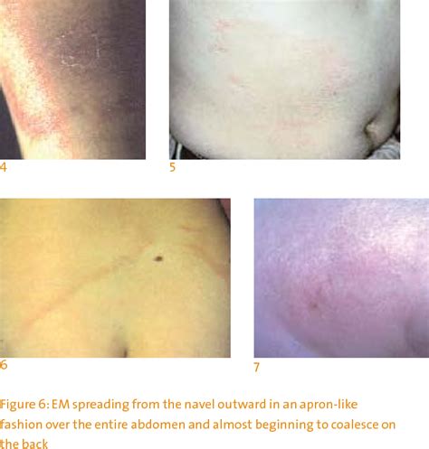 Figure 6 From Cutaneous Manifestations Of Lyme Borreliosis Semantic