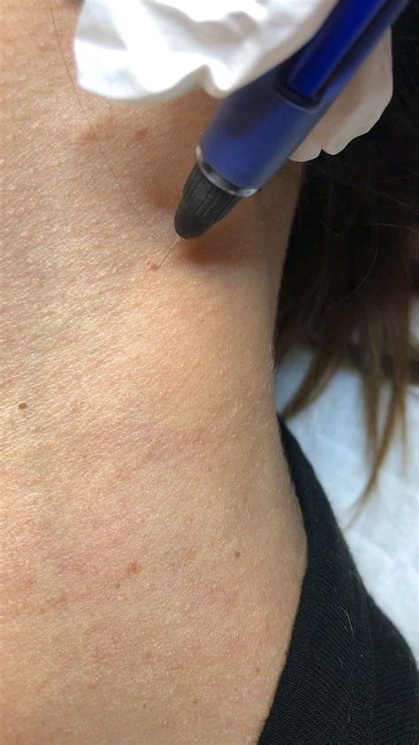 The Complete Guide To Basal Cell Carcinoma Artofit