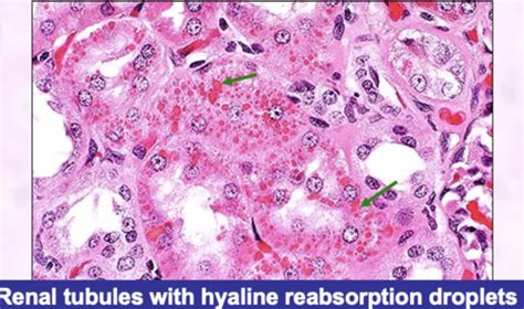 Cell Degeneration Intracellular Accumulations And Amyloidosis