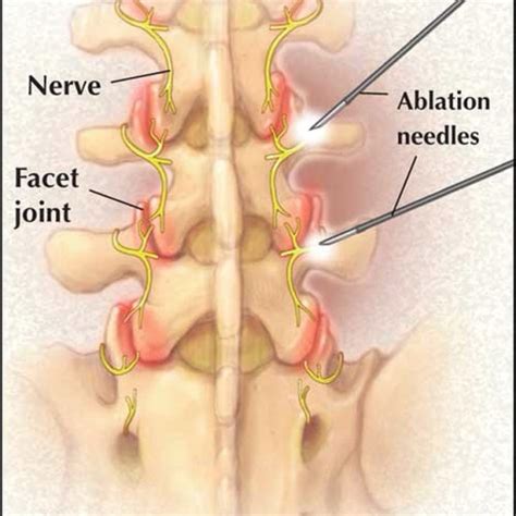 Radiofrequency Ablation ISPINE